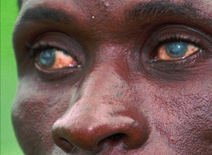 parásitos en los ojos humanos