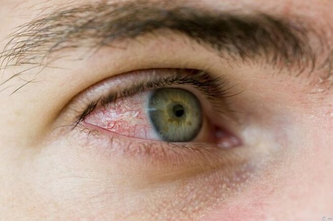 problemas oculares debido a parásitos
